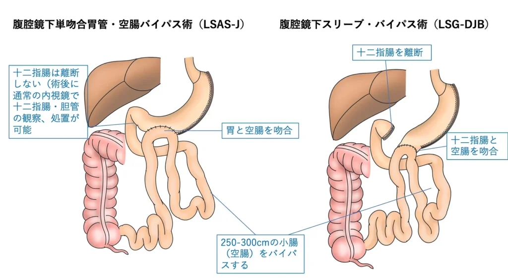 腹腔鏡下単吻合胃管・空腸バイパス術